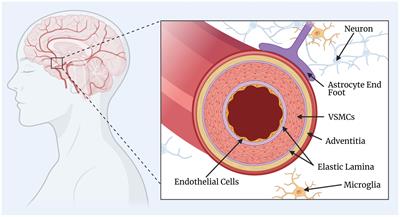 Vascular smooth muscle cell dysfunction in neurodegeneration